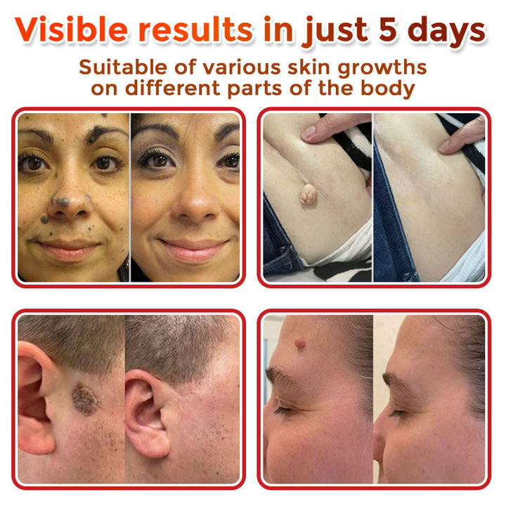 The MicroDerm Patch - Painless Skin Tag &amp; Blemish Removal + 50% OFF